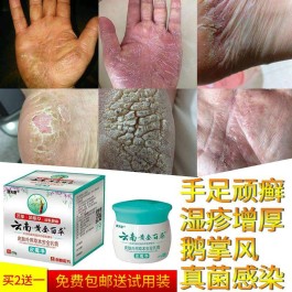 手癣最佳治疗方法(手癣最佳治疗方法是什么)