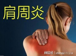 治疗肩周炎最佳方法(治疗肩周炎最佳方法中药)