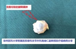 腱鞘囊肿最佳治疗方法(婴儿腱鞘囊肿最佳治疗方法)