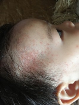 婴儿痱子最佳治疗方法(婴儿囟子的图片)