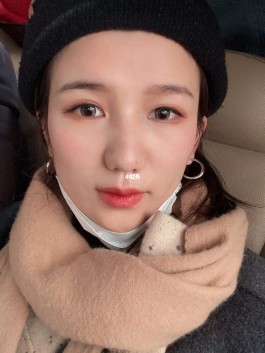 缩小鼻翼方法(缩小鼻翼方法图解)
