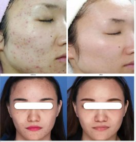 痘痘的治疗方法(严重痘痘的治疗方法)