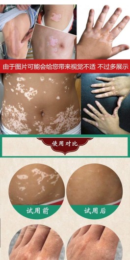 花斑癣最佳治疗方法(白点癫风的初期图)