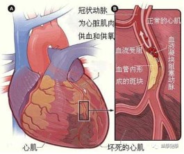 心肌梗塞的治疗方法(心肌梗塞的治疗方法前中后期)