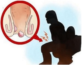 内痔疮的最佳治疗方法(产后内痔疮的最佳治疗方法)