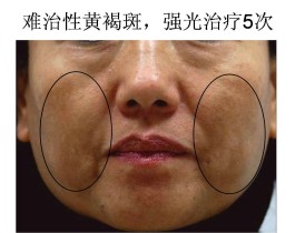 黄褐斑治疗方法(黄褐斑治疗方法有哪些)