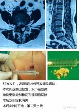 腰间盘突出怎么治疗最好的方法(老人腰间盘突出怎么治疗最好的方法)