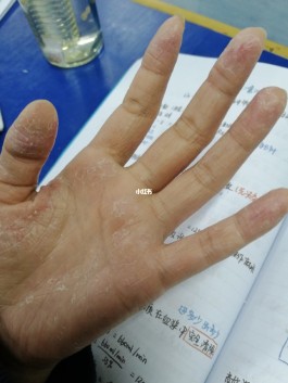 手湿疹最佳治疗方法(扫一扫识别皮肤病)
