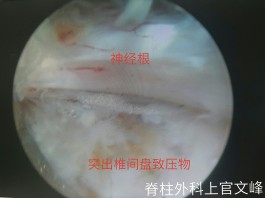 腰椎盘膨出治疗方法(腰椎盘膨出治疗方法有哪些)