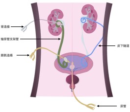 尿潴留最佳治疗方法(顺产后尿潴留最佳治疗方法)