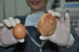 肾结石最好的治疗方法(肾结石最好的治疗方法去贵阳结石病医院)