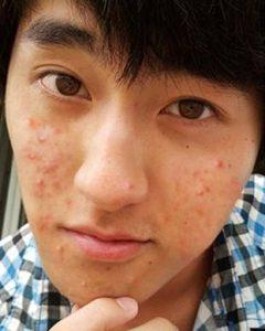 男生祛痘方法(皮肤科医生免费问诊)