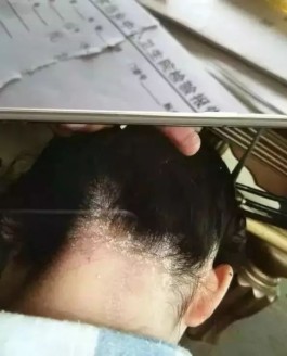 头癣的治疗方法(头癣的治疗方法痊愈吗)