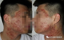 痤疮粉刺的治疗方法(痤疮粉刺痘痘怎么处理)