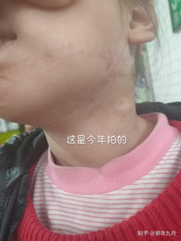 烫伤疤痕治疗方法(烫伤疤痕最好治疗方法)
