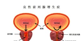 前列腺增生的治疗方法(前列腺增生的治疗方法有哪几种)