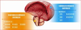 前列腺增大治疗方法(前列腺增大如何治疗)