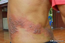 疱疹的治疗方法(无疹性带状疱疹的治疗方法)