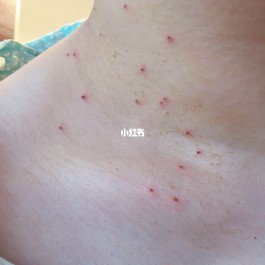 丝状疣最佳治疗方法(丝状疣用什么药膏一涂就掉)