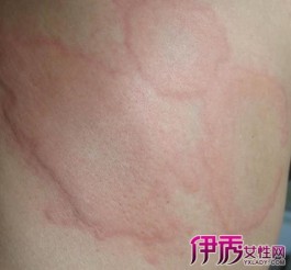 荨麻疹最快治疗方法(人工荨麻疹最快治疗方法)