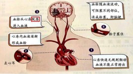 脑梗塞的治疗方法(脑梗塞的治疗方法有哪些?)