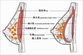 隆胸的方法(怎样隆胸效果好)