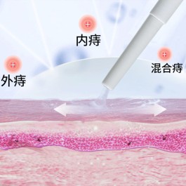混合痔疮的最佳治疗方法(血栓混合痔疮的最佳治疗方法)