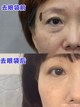去眼袋的最好方法(去眼袋的最好方法小妙招)