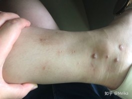 痒疹的治疗方法(痒疹的治疗方法有哪些呢)