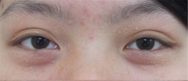 汗管瘤的治疗方法(汗管瘤的治疗方法抹药可以吗?)