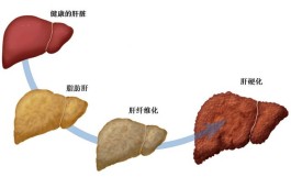 治疗脂肪肝最佳方法(治疗脂肪肝最佳方法有哪些)