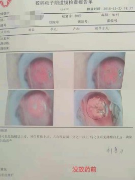 宫颈糜烂治疗方法(宫颈糜烂治疗方法有哪些)