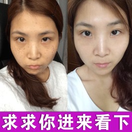 去黄褐斑的最佳方法(去黄褐斑妙方一招搞定)