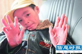 鱼鳞病最佳治疗方法(草鱼脱鳞病的原因及治疗)