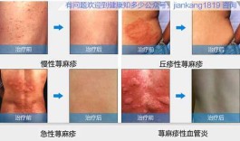 寻麻疹的治疗方法(皮肤科医生免费问诊)