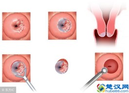 宫颈糜烂的治疗方法(宫颈糜烂的治疗方法有几种)