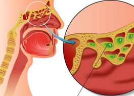 鼻窦炎的治疗方法(鼻窦炎的治疗方法和注意事项)