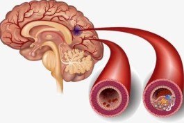 脑梗塞最佳治疗方法(大面积脑梗塞最佳治疗方法)
