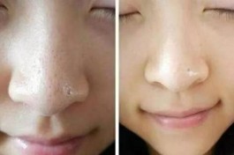 清洁毛孔最有效的方法(清洁毛孔最有效的产品)