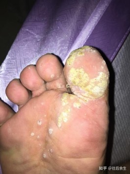 趾疣的最好治疗方法(趾疣怎么彻底根除)