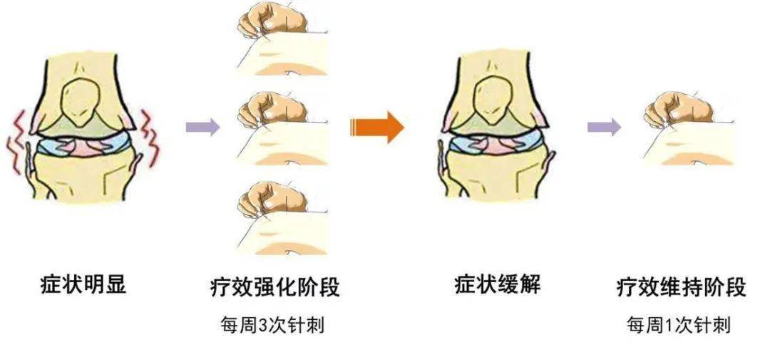 膝关节炎的治疗方法(膝关节炎的治疗方法偏方)