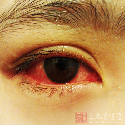 红眼病治疗方法(红眼病的治疗)