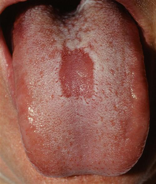 舌炎的治疗方法(慢性舌炎的症状及治疗)