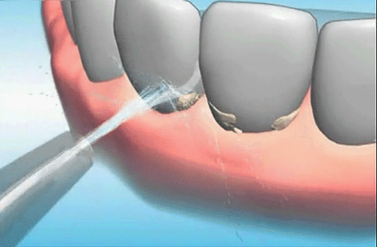 牙釉质损伤修复方法(牙齿咨询免费医生)