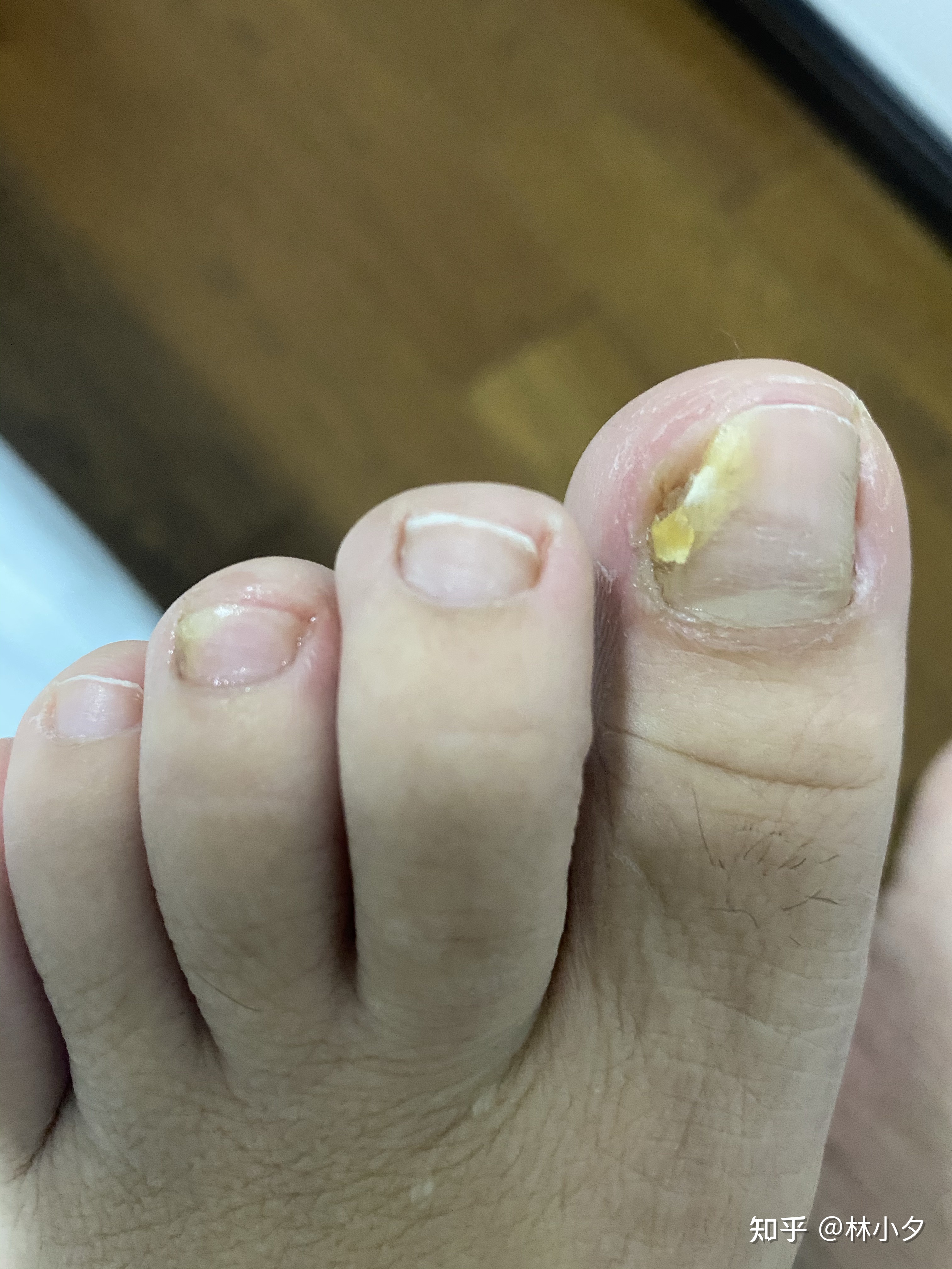 灰指甲初期脚趾头图片
