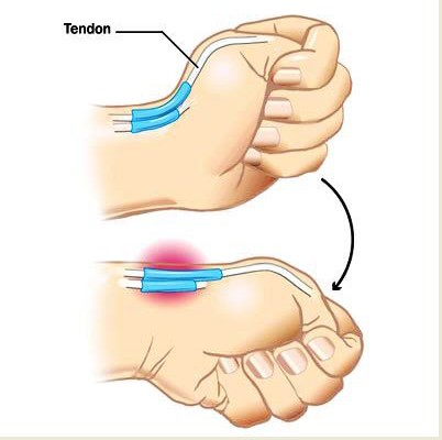 手腕腱鞘炎治疗方法(治疗手腕腱鞘炎的有效方法)